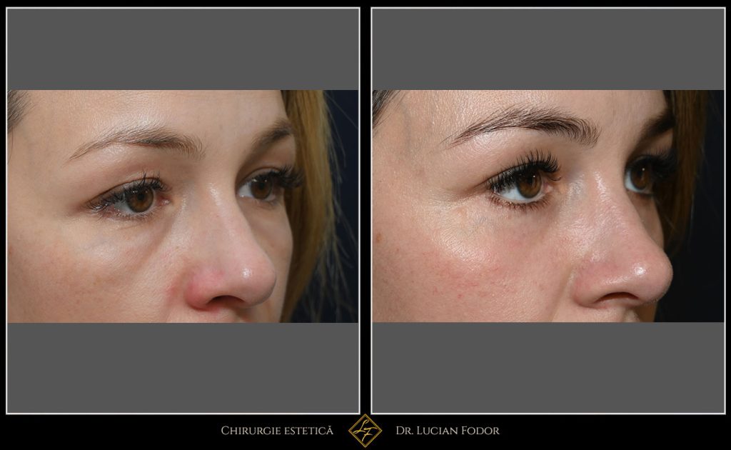Blefaroplastie / Întinerire pleoape - Caz 32 Foto 2