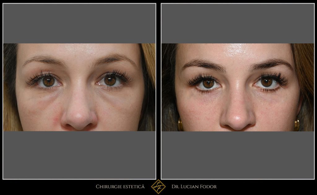 Blefaroplastie / Întinerire pleoape - Caz 32 Foto 1