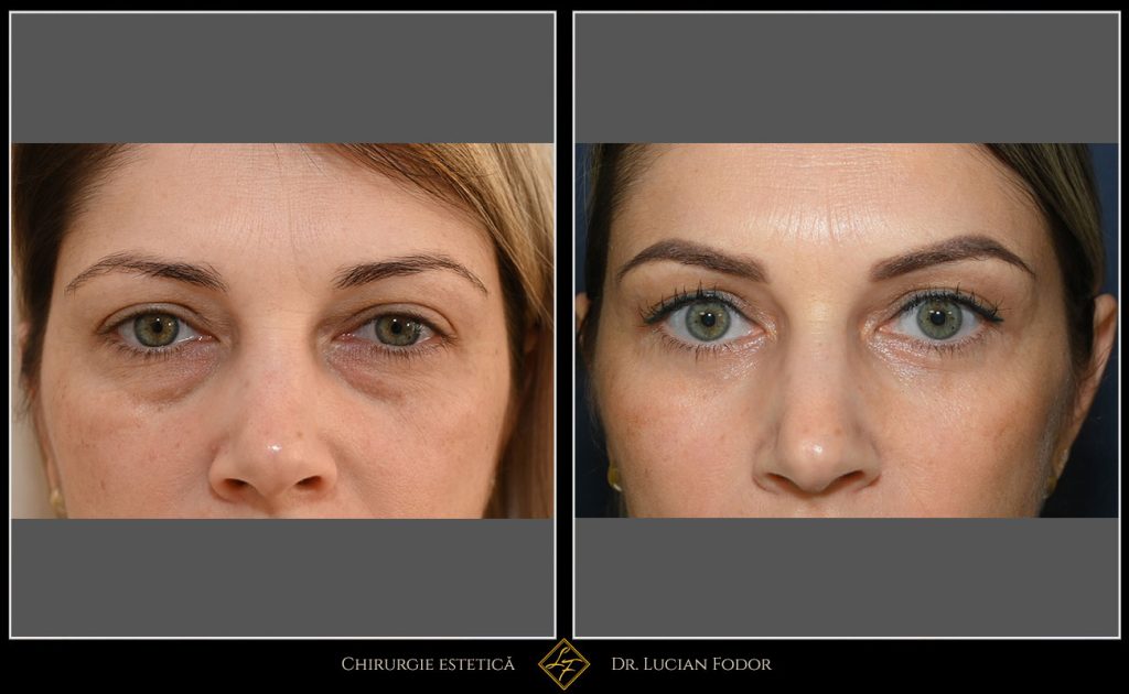Blefaroplastie inferioară: întinerirea privirii prin tehnică chirurgicală avansată - Caz 34 Foto 1