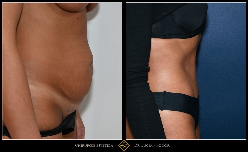 Abdominoplastie - Caz 32 Foto 1