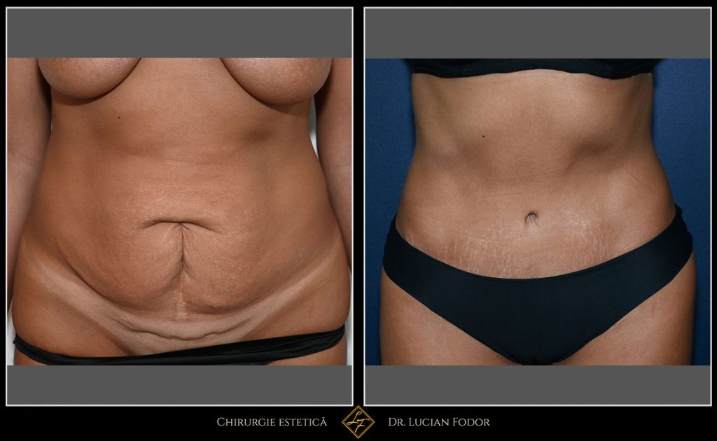 Abdominoplastie - Caz 32 Foto 2
