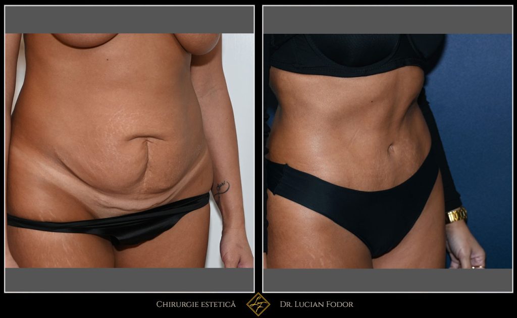 Abdominoplastie - Caz 32 Foto 3