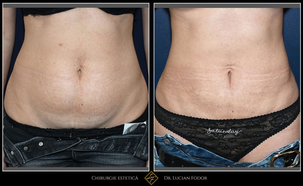 Abdominoplastie - Caz 33 Foto 2