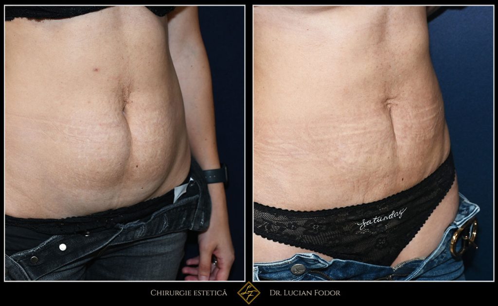 Abdominoplastie - Caz 33 Foto 3