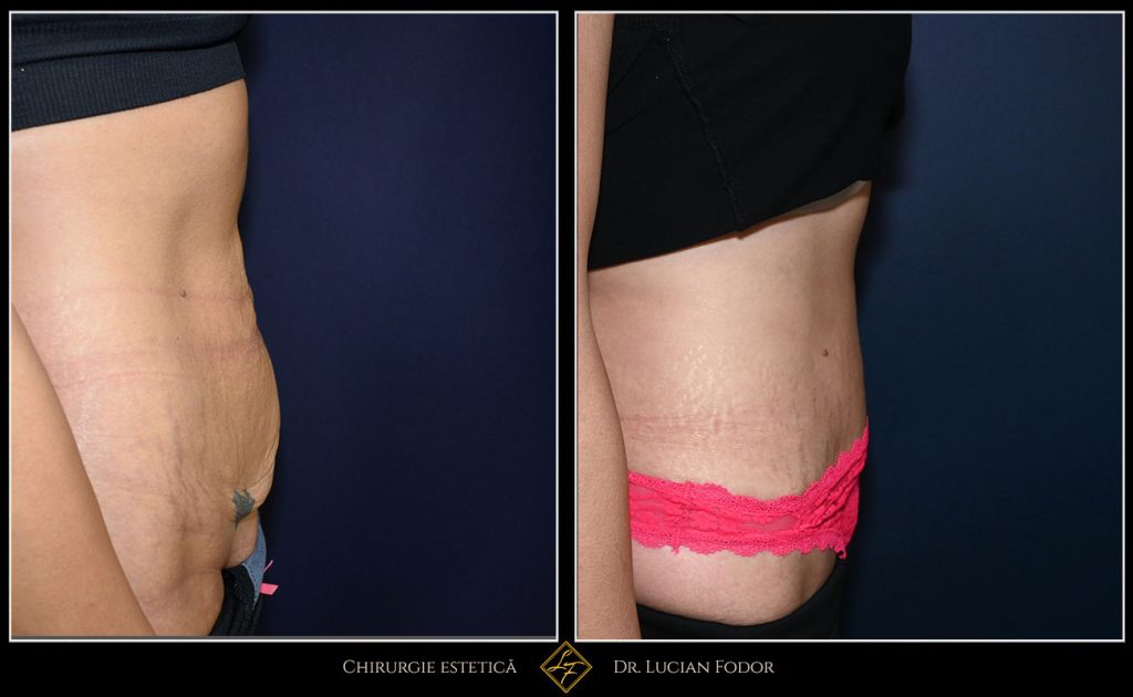 Abdominoplastie cu corectarea diastazei musculare și lifting pubian - Caz 34 Foto 1