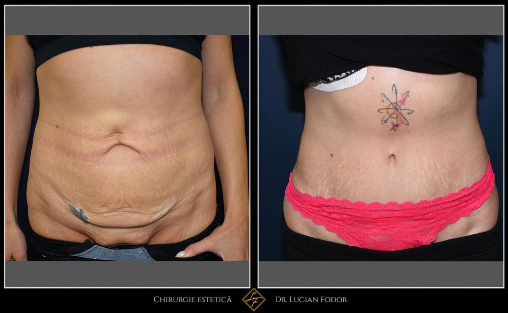 Abdominoplastie cu corectarea diastazei musculare și lifting pubian - Caz 34 Foto 2