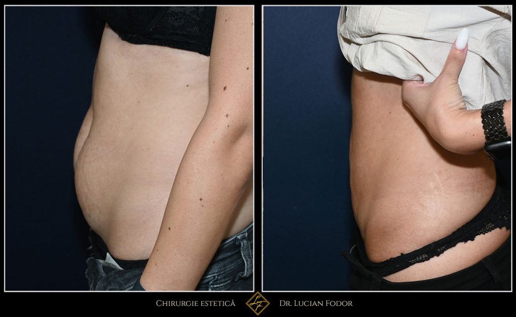 Miniabdominoplastie cu liposucție și întărirea peretelui abdominal - - Caz 35 Foto 1