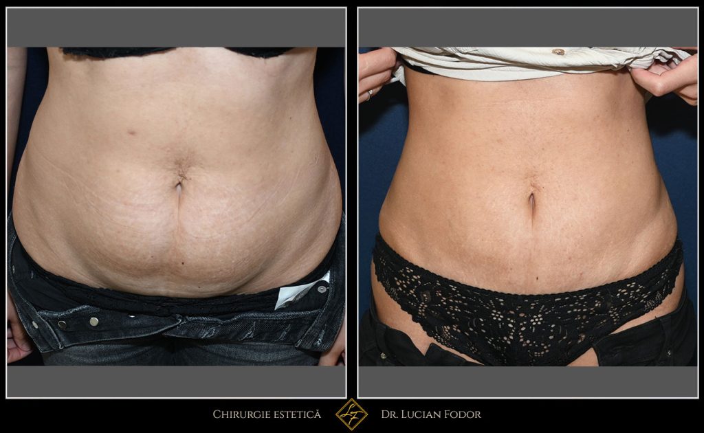 Miniabdominoplastie cu liposucție și întărirea peretelui abdominal - - Caz 35 Foto 2