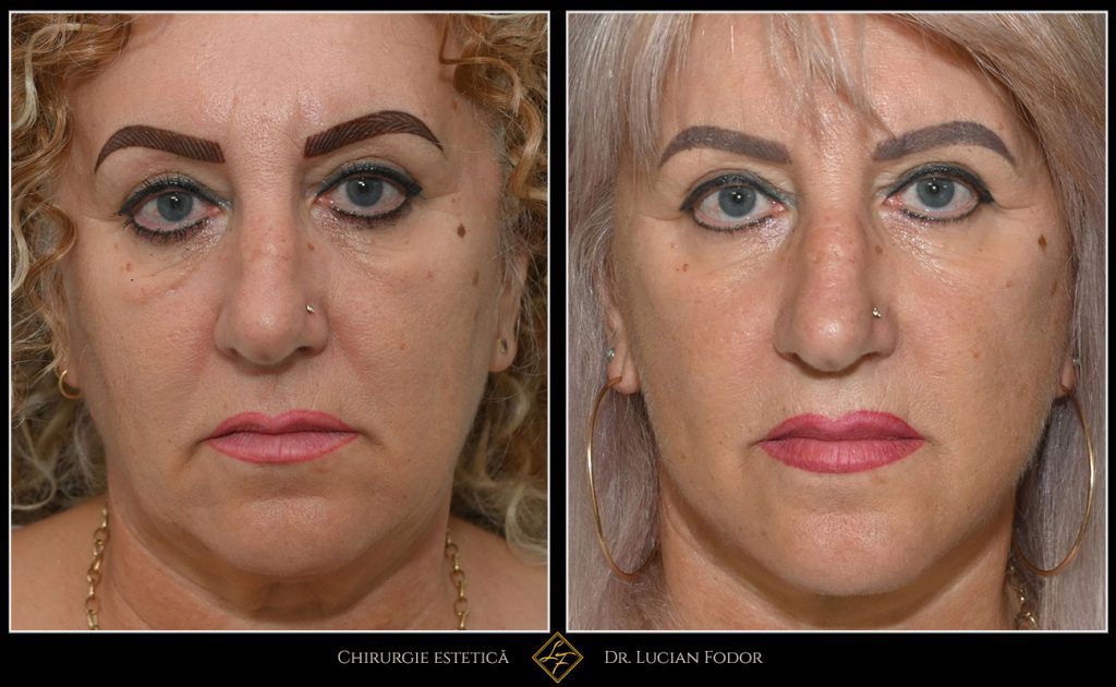 Deep Plane Facelift – întinerire naturală și restaurarea conturului facial - Caz 19 Foto 1