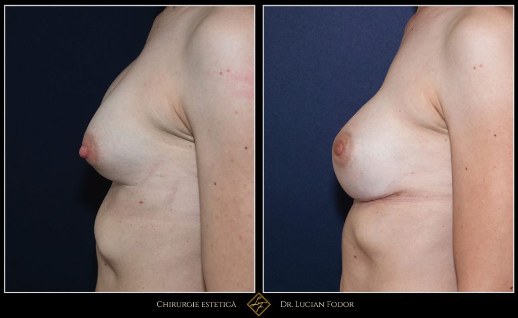 Mărire sâni/Implant silicon: înlocuire implant - Caz 101 Foto 1