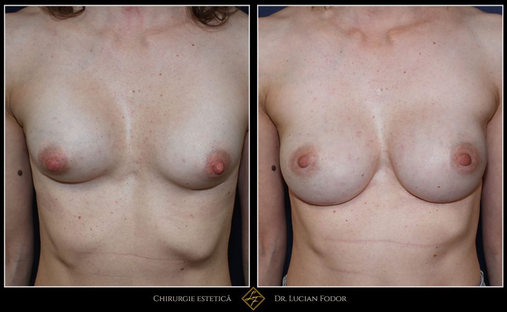 Mărire sâni/Implant silicon: înlocuire implant - Caz 101 Foto 2