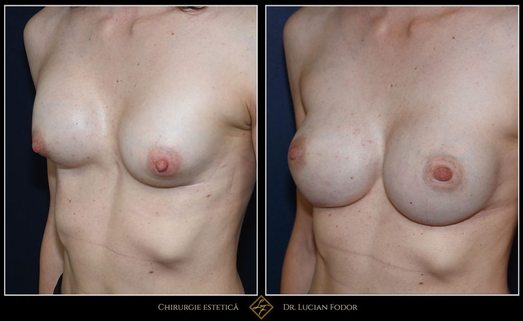 Mărire sâni/Implant silicon: înlocuire implant - Caz 101 Foto 3
