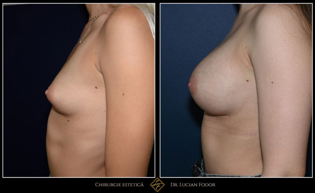 Mărire sâni/Implant silicon: înlocuire implant - Caz 102 Foto 1
