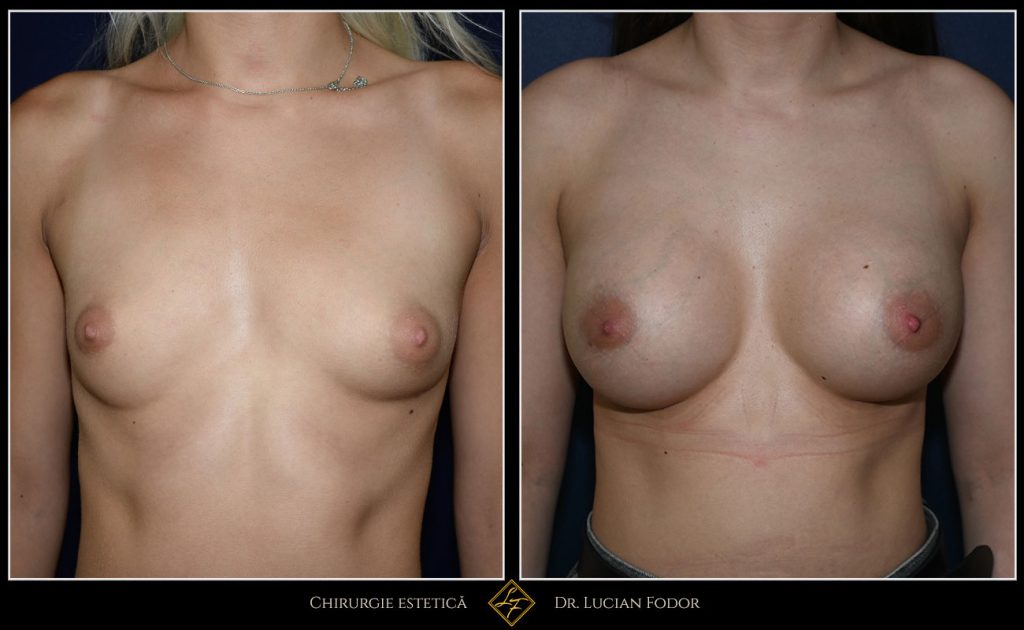 Mărire sâni/Implant silicon: înlocuire implant - Caz 102 Foto 2