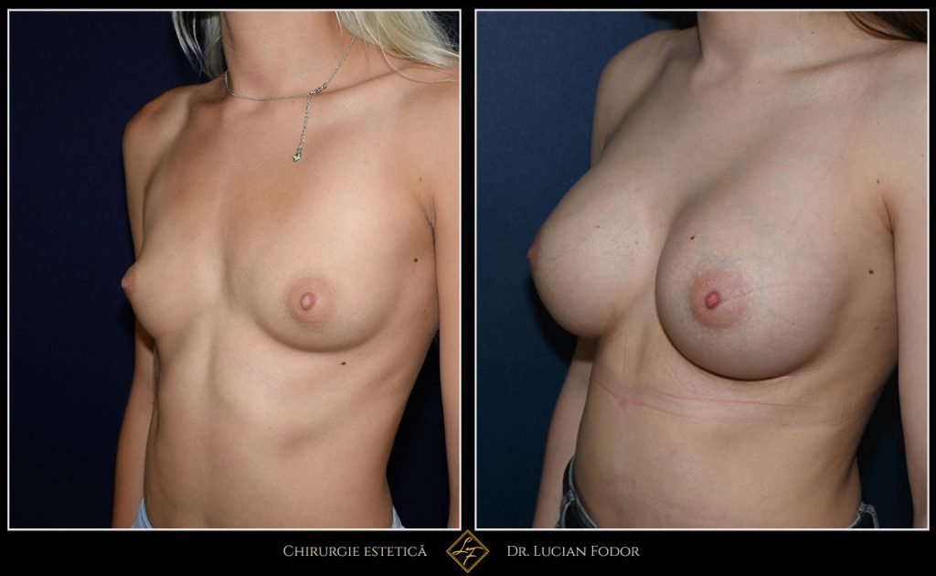Mărire sâni/Implant silicon: înlocuire implant - Caz 102 Foto 3