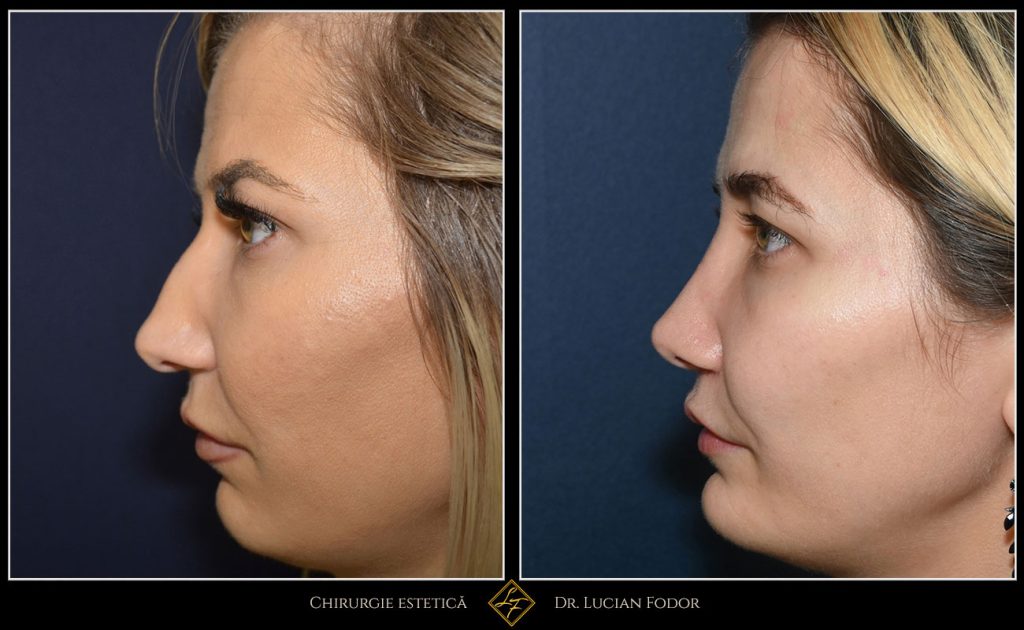 Rinoplastie - Operație nas, cu implant bărbie, Caz 255 Foto 1