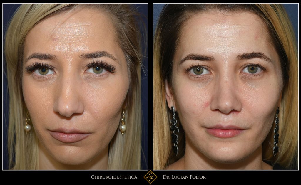 Rinoplastie - Operație nas, cu implant bărbie, Caz 255 Foto 2