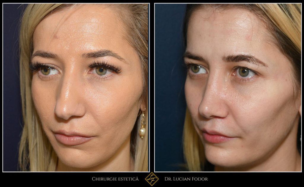 Rinoplastie - Operație nas, cu implant bărbie, Caz 255 Foto 3