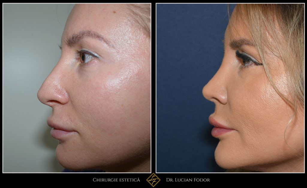 Rinoplastie secundară - Operație nas, Caz 256 Foto 1
