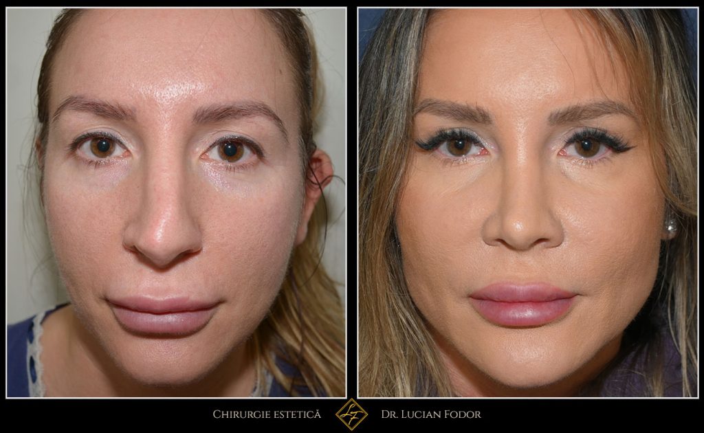 Rinoplastie secundară - Operație nas, Caz 256 Foto 2