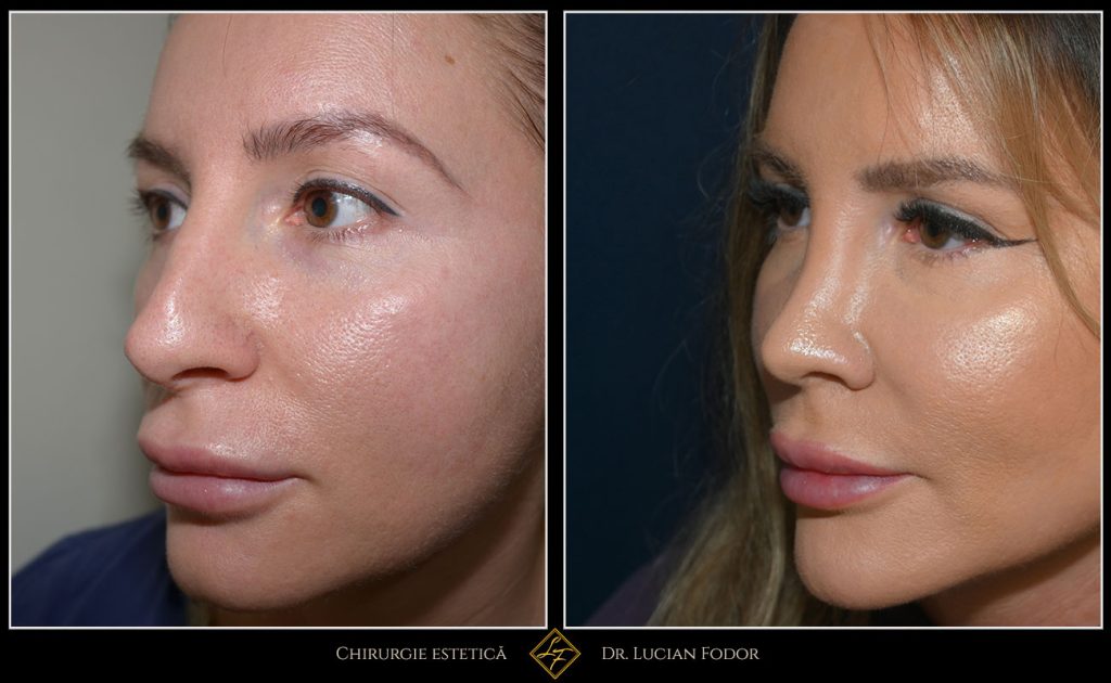 Rinoplastie secundară - Operație nas, Caz 256 Foto 3
