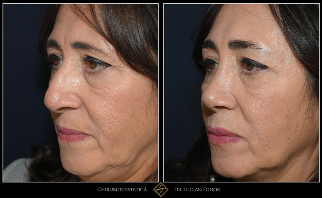 Rinoplastie închisă, corecție deviație sept - Caz 257 Foto 1