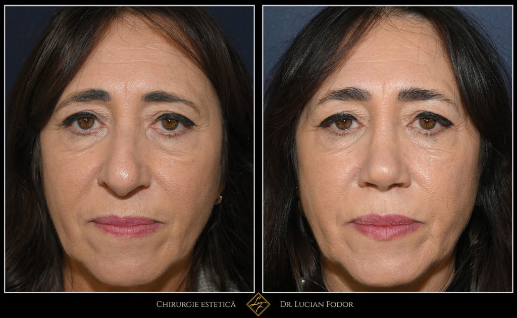 Rinoplastie închisă, corecție deviație sept - Caz 257 Foto 2