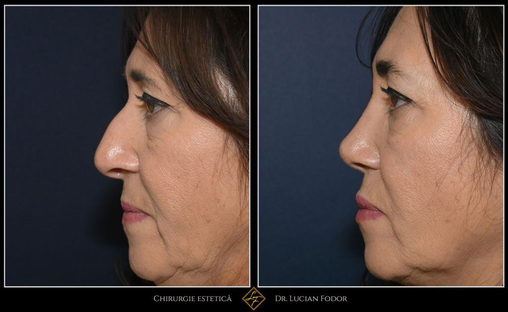 Rinoplastie închisă, corecție deviație sept - Caz 257 Foto 3