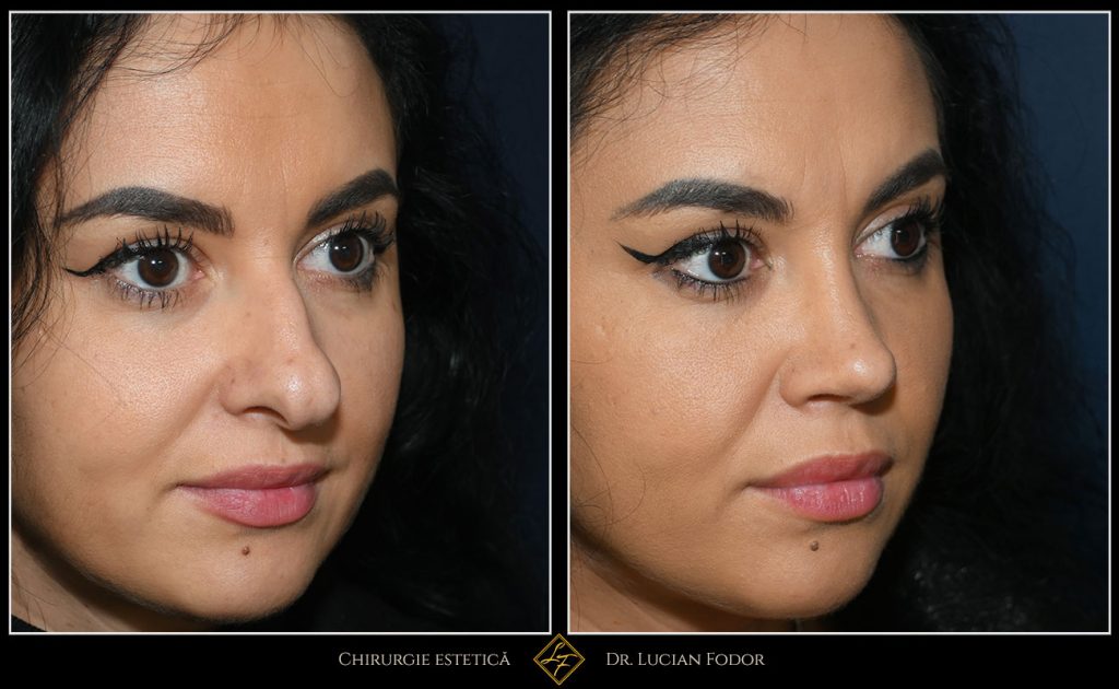Rinoplastie deschisă, corecție malformație nas - Caz 258 Foto 1