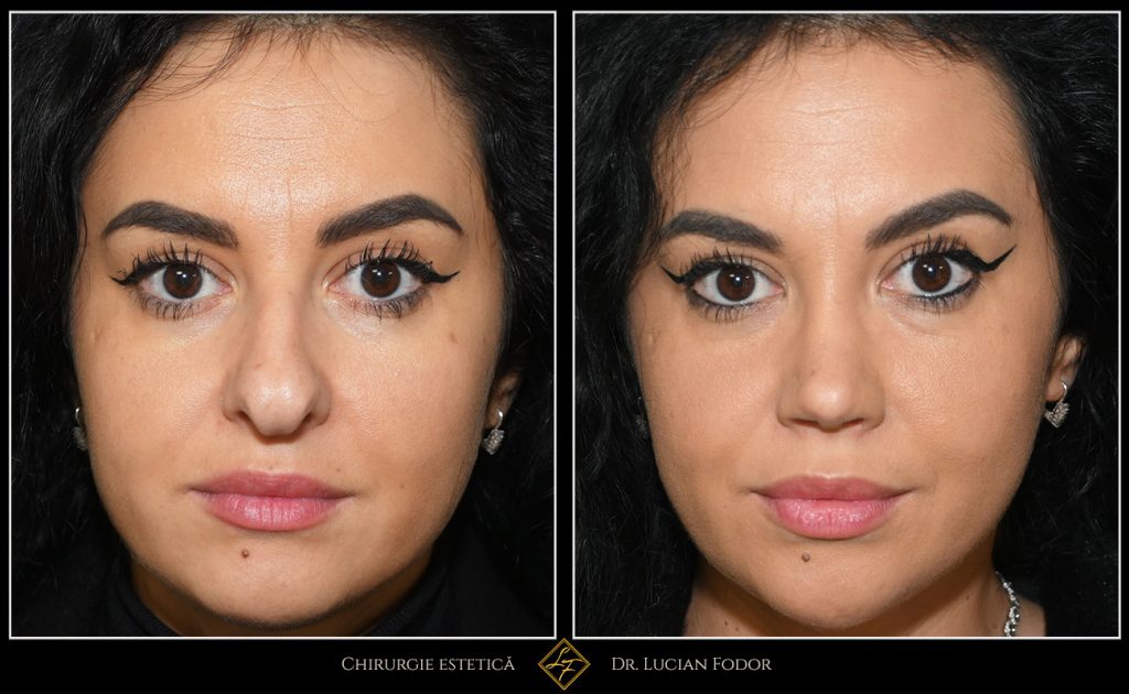 Rinoplastie deschisă, corecție malformație nas - Caz 258 Foto 2