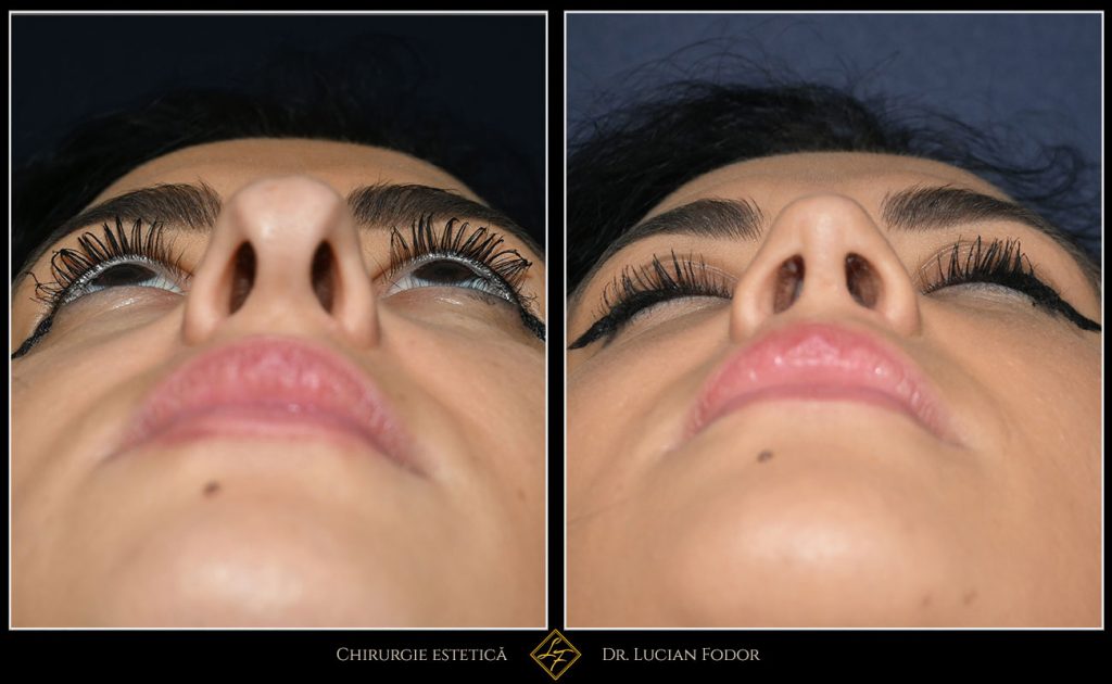 Rinoplastie deschisă, corecție malformație nas - Caz 258 Foto 3