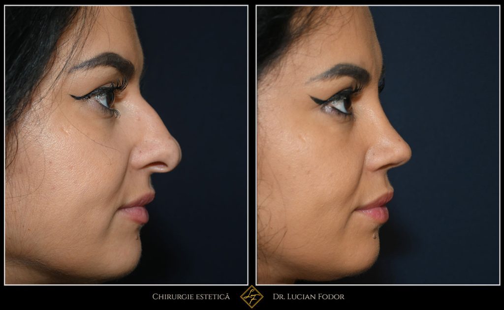 Rinoplastie deschisă, corecție malformație nas - Caz 258 Foto 4