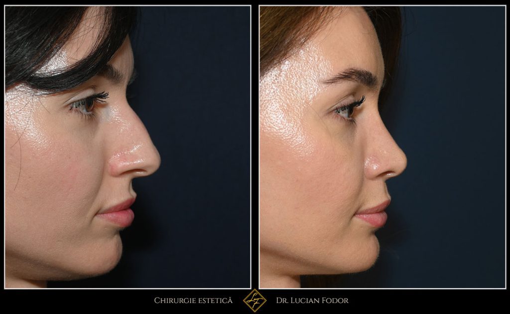 Rinoseptoplastie închisă – profil mai feminin și respirație îmbunătățită - Caz 259 Foto 1