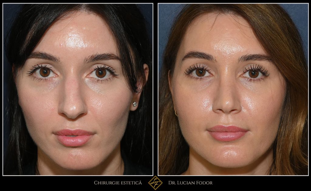 Rinoseptoplastie închisă – profil mai feminin și respirație îmbunătățită - Caz 259 Foto 2