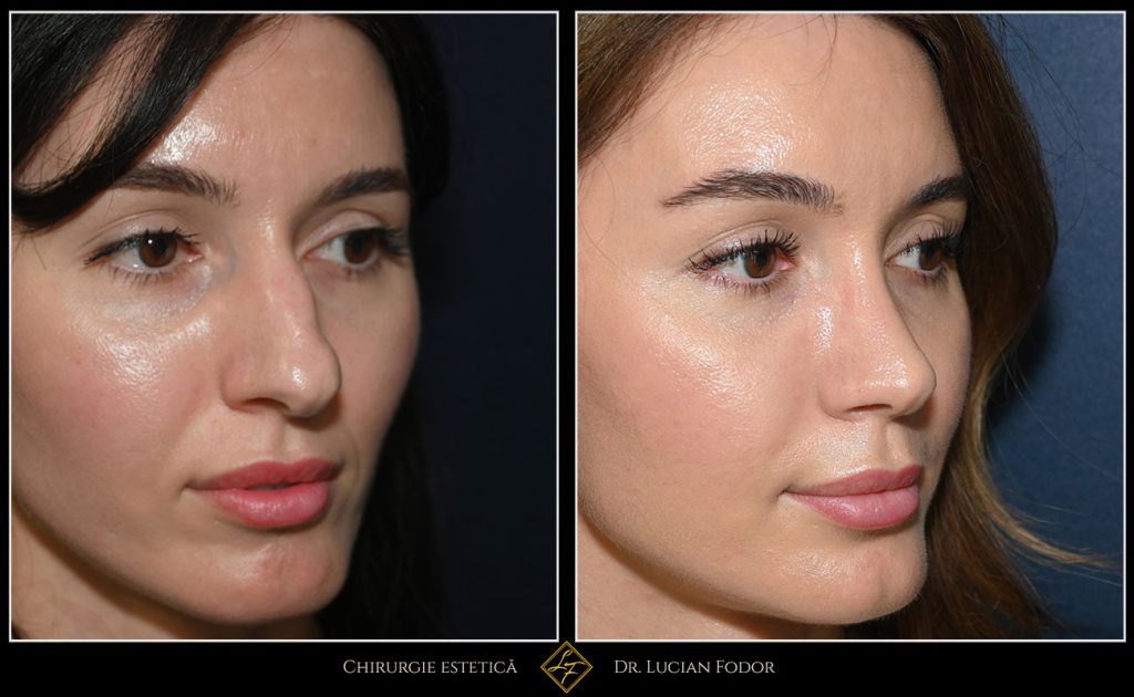 Rinoseptoplastie închisă – profil mai feminin și respirație îmbunătățită - Caz 259 Foto 3