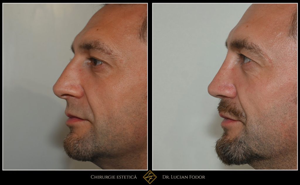 Rinoseptoplastie închisă cu grefe de cartilaj, rinoplastie bărbați - Caz 260 Foto 1