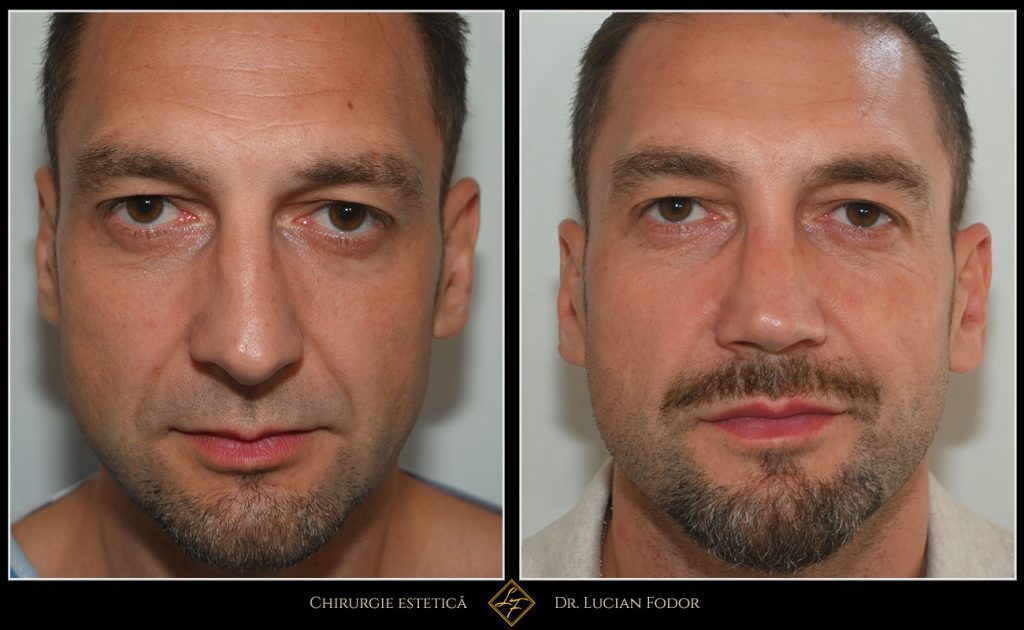 Rinoseptoplastie închisă cu grefe de cartilaj, rinoplastie bărbați - Caz 260 Foto 2
