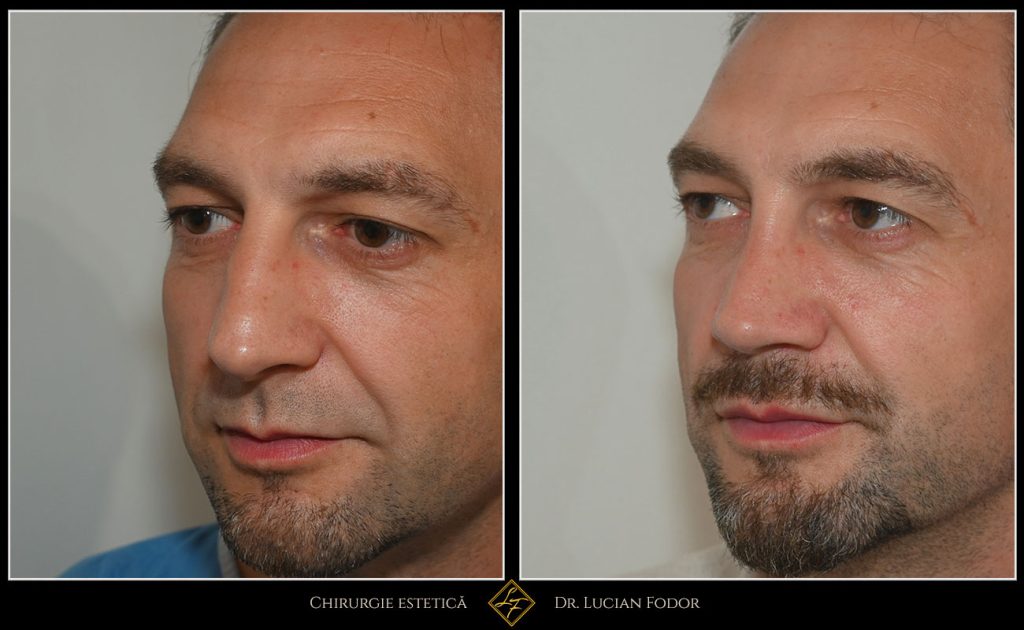 Rinoseptoplastie închisă cu grefe de cartilaj, rinoplastie bărbați - Caz 260 Foto 3